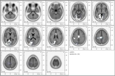 Ce sont des images eLORETA des sources d'ondes alpha EEG au cours de la Méditation Transcendantale par rapport au repos les yeux fermés