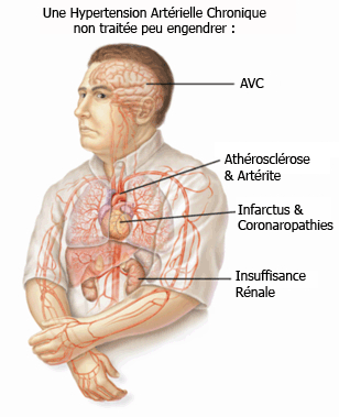 HTA chronique non traitée